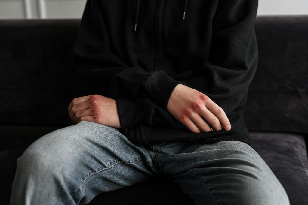 Understanding Burn Injuries and Prevention: Protecting Your Child
