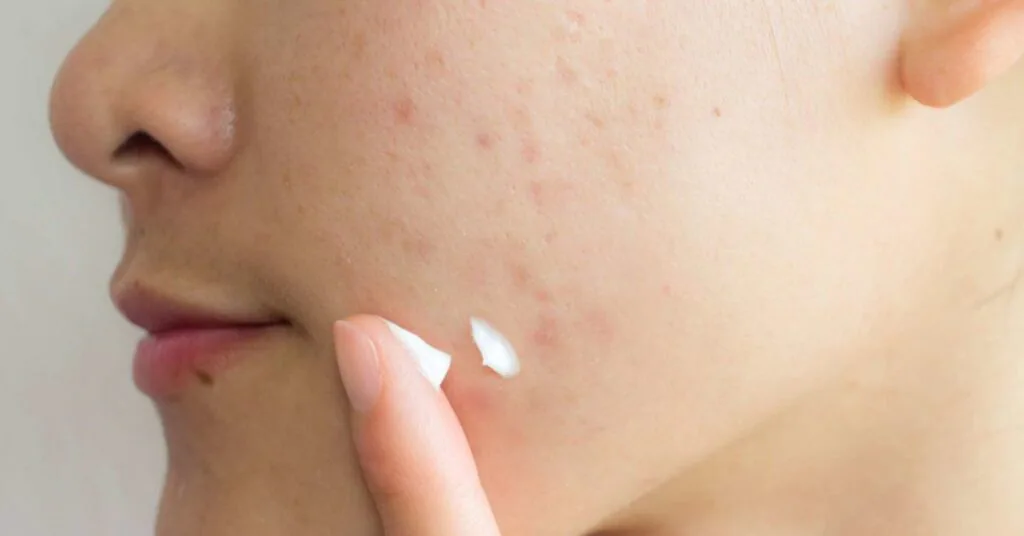 What Acne Scar Treatments to Use