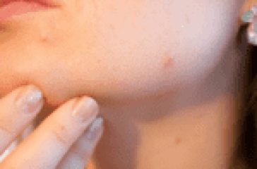 Acne Clearing Gels