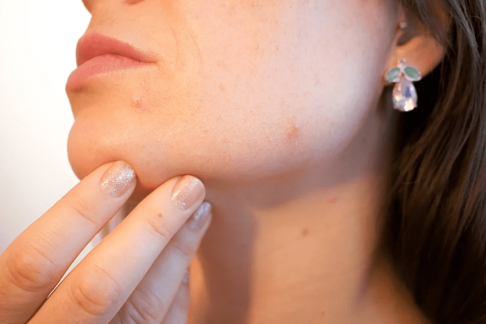 6 Amazing Benefits of Acne Clearing Gels