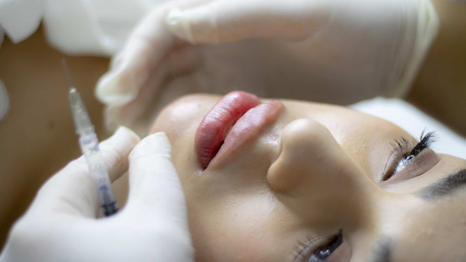 7 Ways You Can Benefit from Lip Fillers