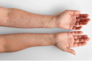 Forearms with visible signs of guttate psoriasis, showcasing small red lesions on skin.