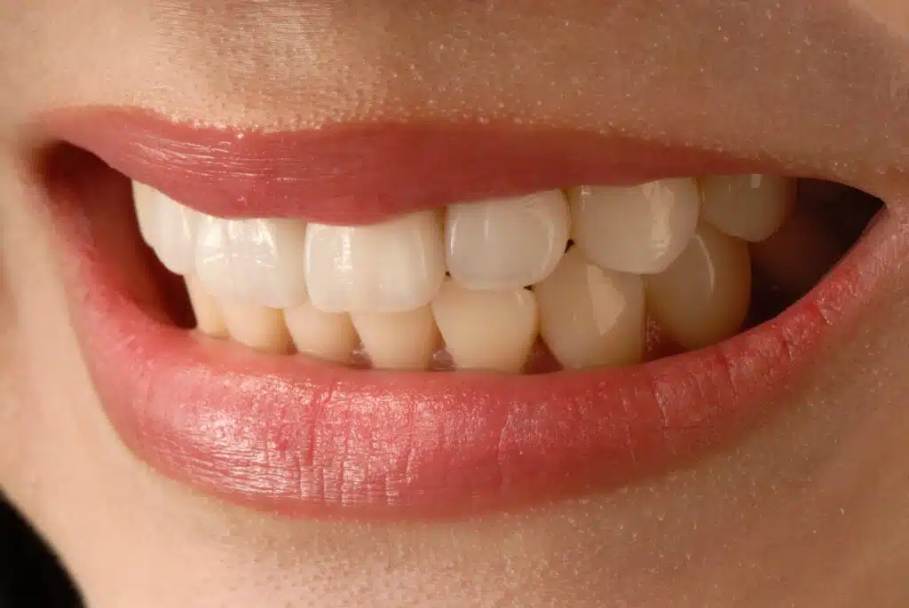 6 Misconceptions Sydneysiders Need To Learn About Porcelain Veneers 6 Misconceptions Sydneysiders Need To Learn About Porcelain Veneers