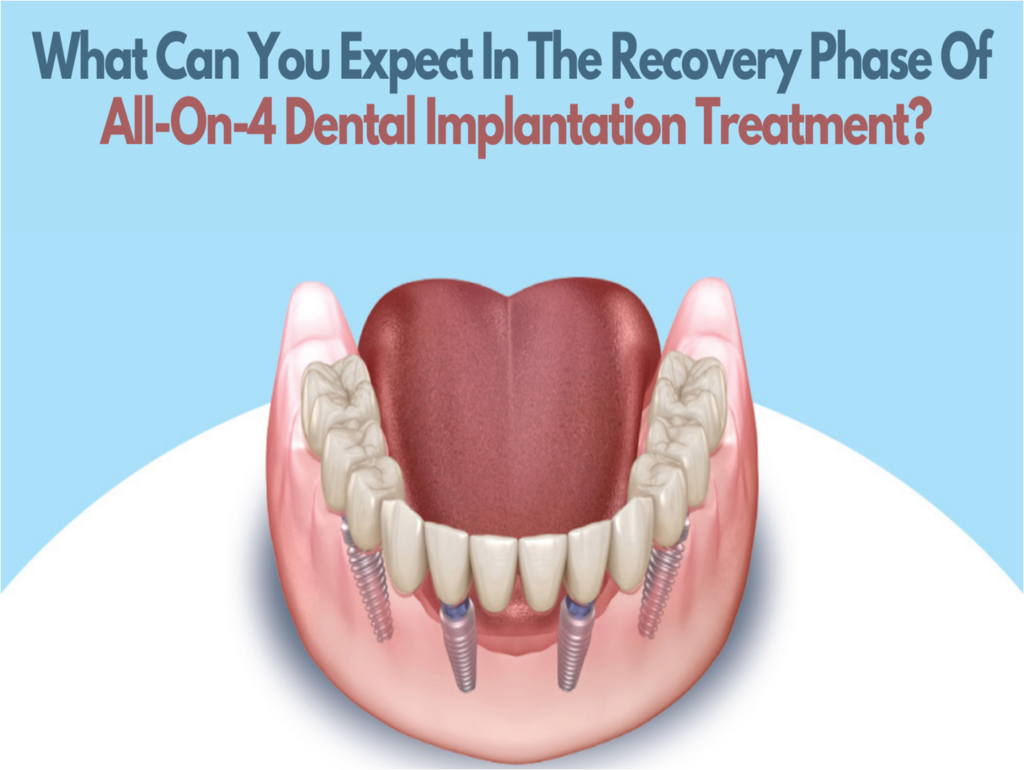 What Can You Expect In The Recovery Phase Of All-On-4 Dental Implantation Treatment?