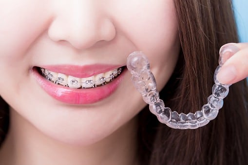 Five Shocking Ways to Straighten Your Teeth Without Braces