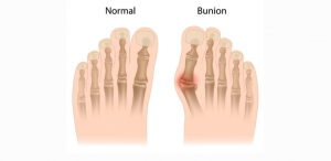 Bunion Treatment