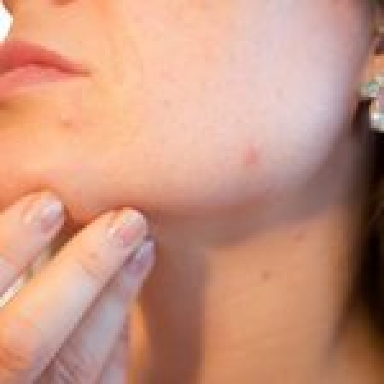 acne-g63f44c67d_1920