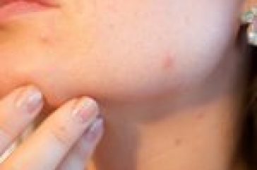 acne-g63f44c67d_1920