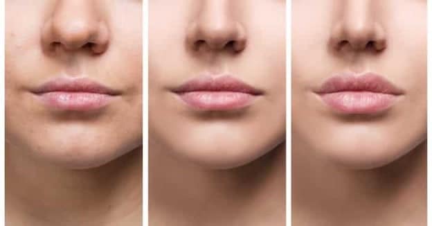 Are lip injections right for you?