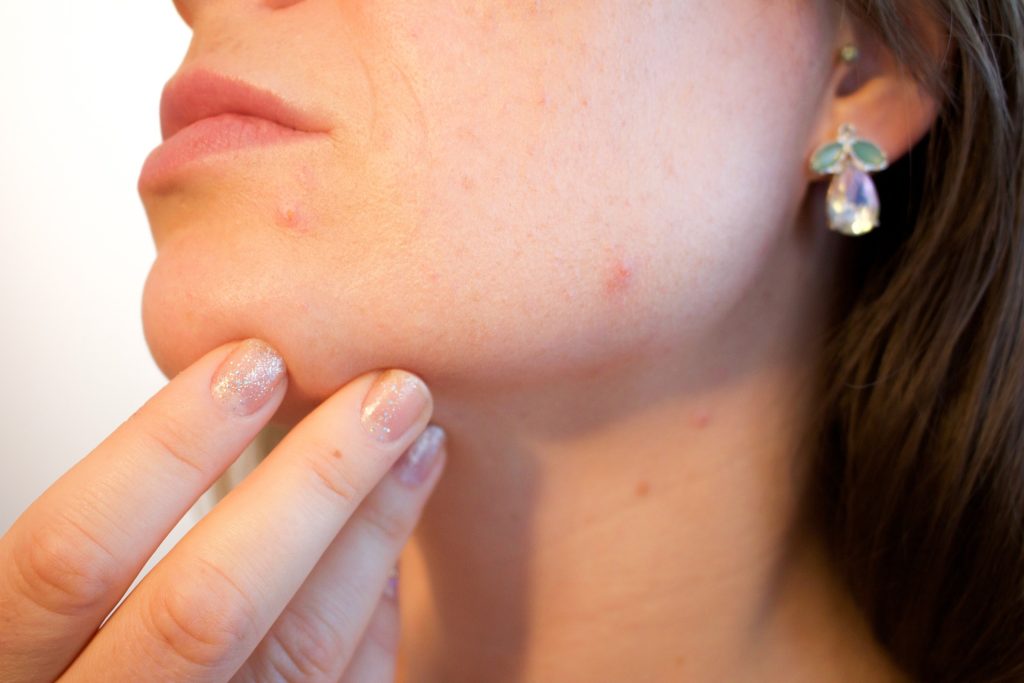 5 Ways To Reduce Acne Breakouts 5 Ways To Reduce Acne Breakouts