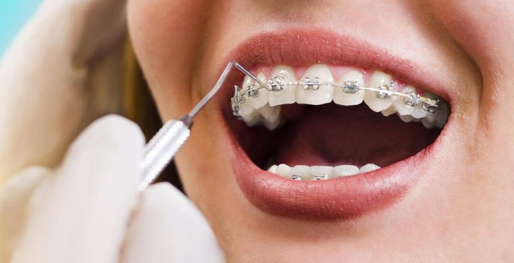 The Best age for orthodontic treatment