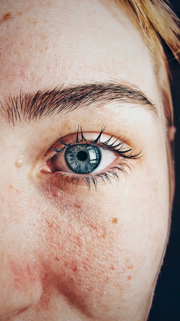 The Three Different Types Of Melasma