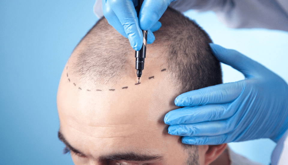 Hair Transplant Turkey and Hair Transplant Techniques