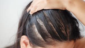 Will Severe Hair Loss Cause a Hair Transplant to Be More Expensive?