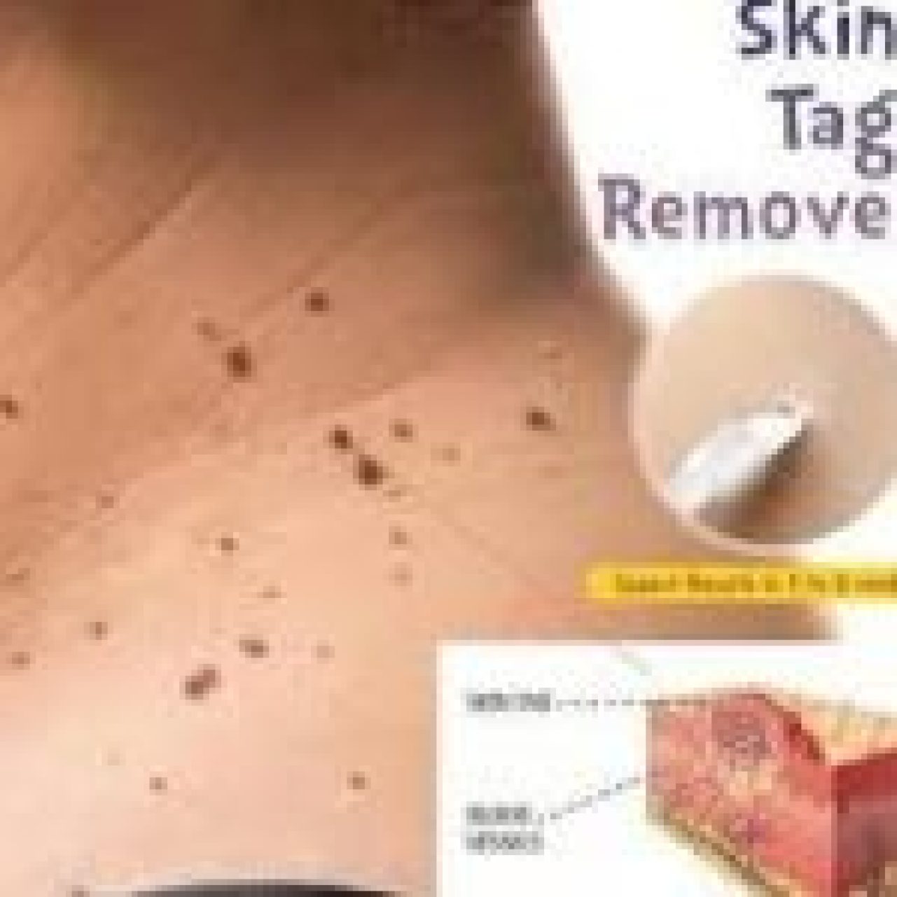 Bliss Skin Tag Remover