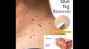 Bliss Skin Tag Remover: Say Goodbye to Unwanted Skin Tags