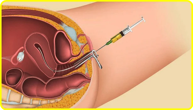 Prognosis of IUI treatment – everything you need to know
