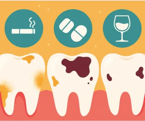 Tooth Decay And Erosion: Illustrated Close-Up Of Teeth Showing Erosion From Acids And Decay Spots, With Icons Of Cigarettes, Pills, And Wine Glasses Representing Unusual Causes In 2025.