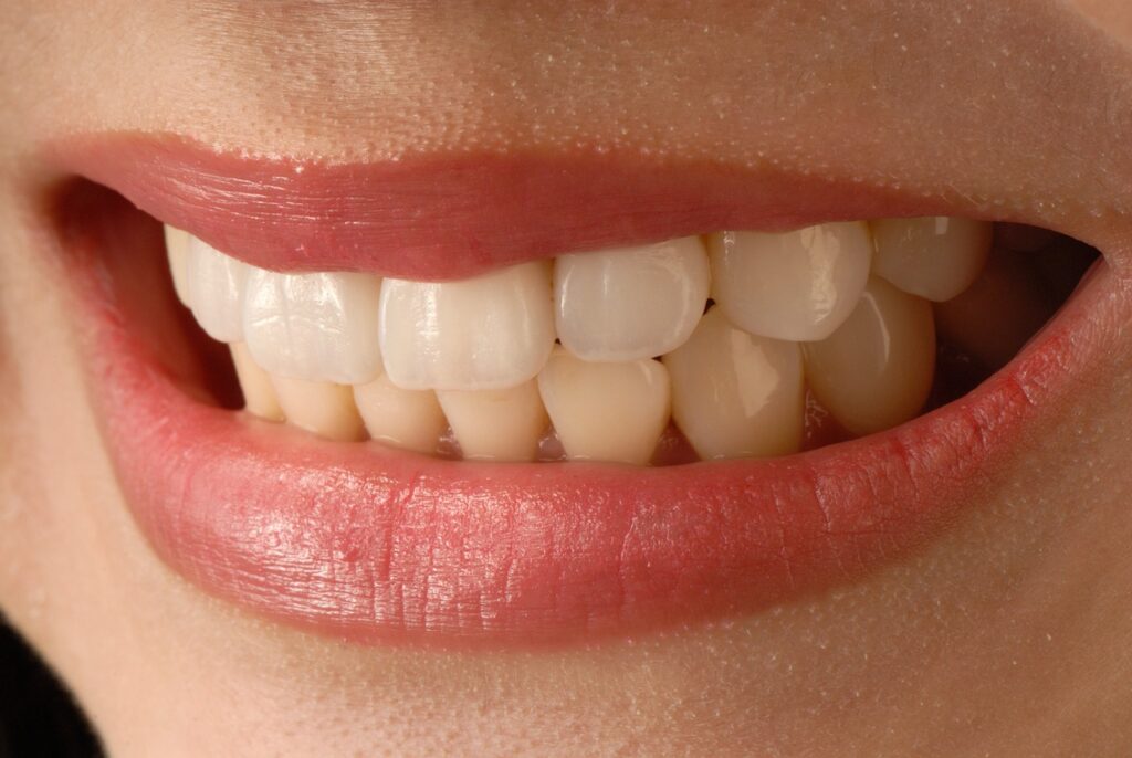 Unlock Your Perfect Smile with Veneers in Brisbane: The Ultimate Guide