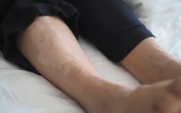 Close-Up Of Leg Showing Skin Thickening And Discoloration From Elephantiasis Or Advanced Lymphedema