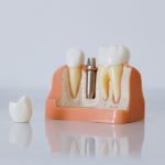 Pexels Cottonbro 6502343 Dental Implants At Great Expressions Dental Centers