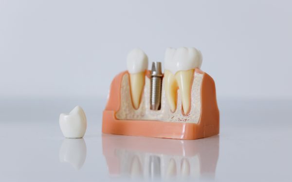 Pexels Cottonbro 6502343 Dental Implants At Great Expressions Dental Centers