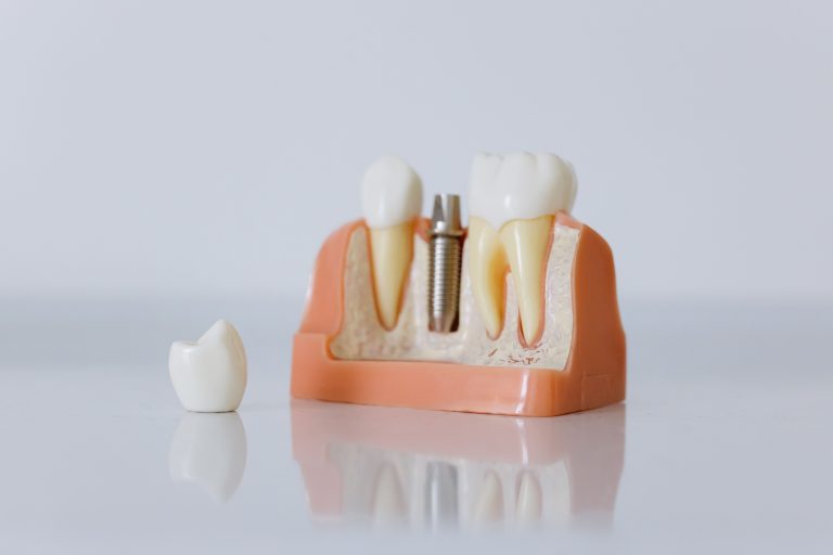 Pexels Cottonbro 6502343 Dental Implants At Great Expressions Dental Centers